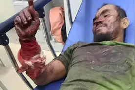 菲律宾男子咬死3米巨蟒：遭蟒蛇咬伤缠身后，狠咬蛇脖子自救