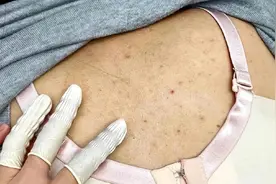后背祛痘全过程，21天恢复干净皮肤！视频封面