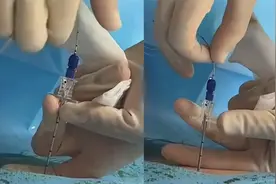 女子记录打无痛分娩针全程，6cm的针头直接刺入腰椎：留给丈夫看视频封面