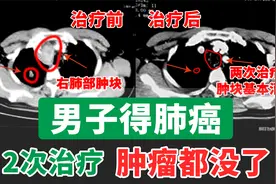 急！男子得肺癌，咳嗽不止，脸肿得厉害，2次治疗，肿瘤基本消失视频封面