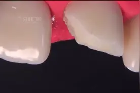 门牙断了一块？别慌！来看看门牙是怎么补好的！
