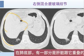 看一个肺癌CT，了解肺结节2个恶性征象，早期手术效果好视频封面
