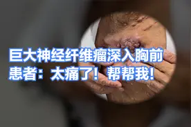 巨大神经纤维瘤深入胸腔内，求医活着只为照顾儿子