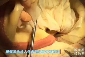 医学生模拟肠道手术的正确过程演示