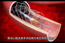 心脏支架3年，再次出现堵塞，4个原因没有重视，给您解决办法视频封面