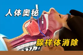 1分钟动画演示，带你了解扁桃体及腺样体手术过程