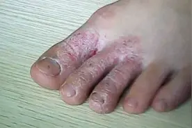 脚趾缝长水泡烂脚丫还痒？分享个超实用的方法，过来人亲测有效！视频封面