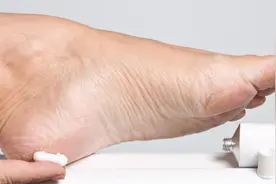 脚后跟开裂起硬皮，1个药膏坚持涂，促进裂口愈合，让双脚嫩滑视频封面