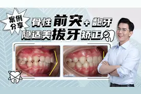 正畸案例分享~青少年拔牙矫正解除骨性前突，引导下颌正常生长！