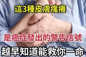 医生提醒：出现3种痒，当心癌细胞已潜伏，早知道能救你一命视频封面