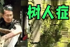 世界上最奇葩的怪病之树人症视频封面