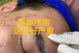 超爽挤痘，这痘好严重