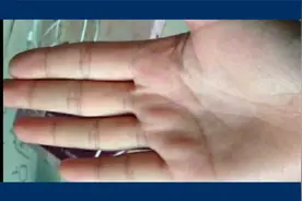 “掌心洼、凹陷”的手相