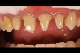 满口牙全部龋坏 全瓷牙冠修复过程