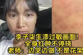 李子柒生漆过敏画面！全身红肿不停挠 老师：边哭边做 不是花架子视频封面