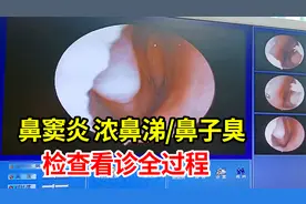小孩鼻窦炎浓鼻涕鼻子臭？检查看诊全过程透明，3岁小孩也能治视频封面