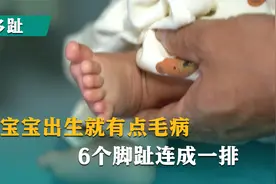 宝宝出生就有点毛病，6个脚趾连成一排视频封面