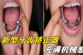 不可思议的牙齿矫正器，两侧有滑轮和连接杆，现实版的“机械嘴”视频封面