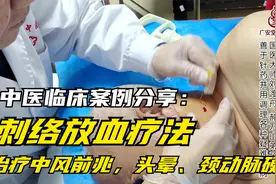 中医临床案例分享：刺络放血疗法治疗中风前兆，头晕、颈动脉硬化