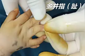 小男孩12根手指，14根脚趾，分开后“我和小朋友一样了”！视频封面