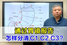 萎缩性胃炎，胃镜报告没写C1、C2、C3，怎么自己判断？