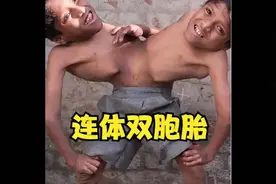 84. 连体双胞胎共用两条腿，很好奇究竟是哪个大脑控制双腿行
