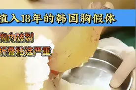 大连美女，植入18年的韩国胸假体，胸内破裂，折叠粘连严重！视频封面