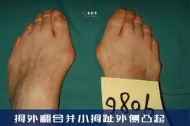 拇外翻合并小拇趾外侧凸起，疼痛原因及处理办法视频封面