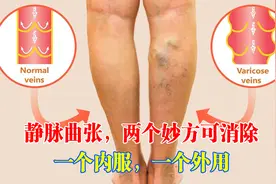 静脉曲张，两个妙方可消除，一个内服，一个外用视频封面