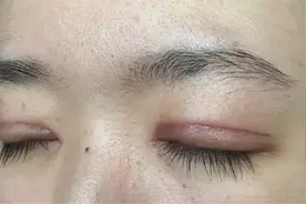 真好用的祛疤方法！双眼皮疤痕告别迷茫！用这三点实现社交无痕！