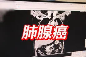 肺腺癌顽强生长，介入治疗为何在北京无效？武主任揭秘背后真相视频封面
