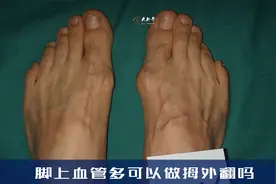 大脚骨手术，脚背青筋暴露做拇外翻手术视频封面