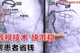 74岁,搭桥后血管又全堵,去最好的医院求医被拒,奔着震波球囊来视频封面