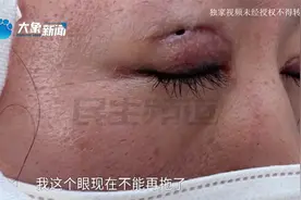 双眼皮修复眼皮多个洞？女子：闭上眼能看到外面视频封面