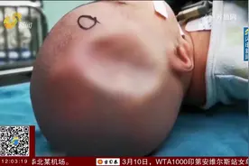 婴儿出生头顶有个“坑”，医生巧用“吸盘”复位视频封面