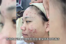 怎么处理脓包痘痘 助你解决脓包痘痘