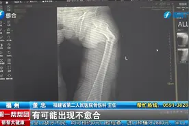 年轻男子剧烈咳嗽，竟导致大腿骨断裂视频封面