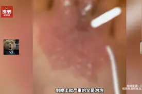 女子去商场光脚试鞋，回家发现惨遭真菌感染脚面全是小泡，痒死了视频封面