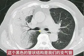 肺粘液腺癌CT特点分析，这种癌细胞会游泳，可随痰液转移视频封面