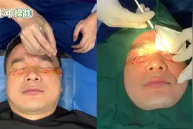手术过程实录，52岁男士做微创去眼袋，术后感叹：一辈子都忘不了视频封面