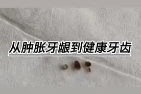 从肿胀牙龈到健康牙齿，我的去牙结石实用攻略大公开！视频封面