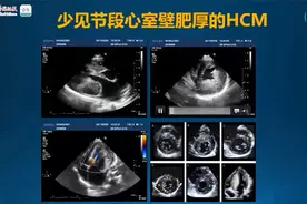 【零基础学心脏超声系列】8. 如何解读肥厚型心肌病超声报告