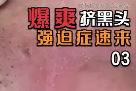 爆爽挤黑头，推荐强迫症观看-03视频封面