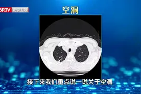 肺结核和肺癌，都会导致肺部出现空洞，但是空洞壁表现不同视频封面