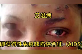 艾滋病，即获得性免疫缺陷综合征（AIDS）