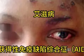 艾滋病，即获得性免疫缺陷综合征（AIDS）视频封面