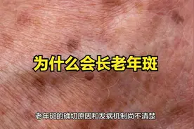 为什么会长老年斑视频封面