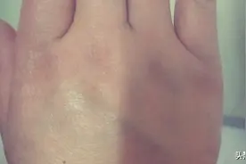为什么当我很伤心的时候整个手都是肿的！图片