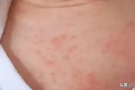 夏季天气炎热，宝宝长痱子不用怕，宝妈们这样做可以快速消除痱子