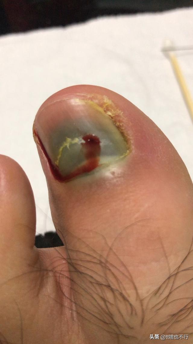 脚趾被砸有淤血怎么办